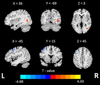 Altered Variability and Concordance of Dynamic Resting-State fMRI Indices in Patients With Attention Deficit Hyperactivity Disorder